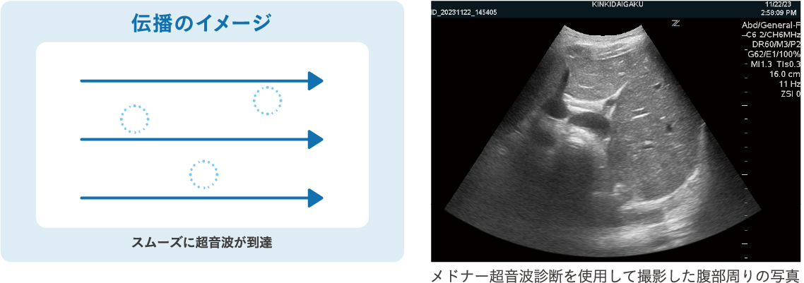 超音波の伝播性を高めてより鮮明に